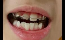 兒童矯正牙齒可以報(bào)銷(xiāo)嗎 兒童矯正牙齒可以用醫(yī)保卡嗎